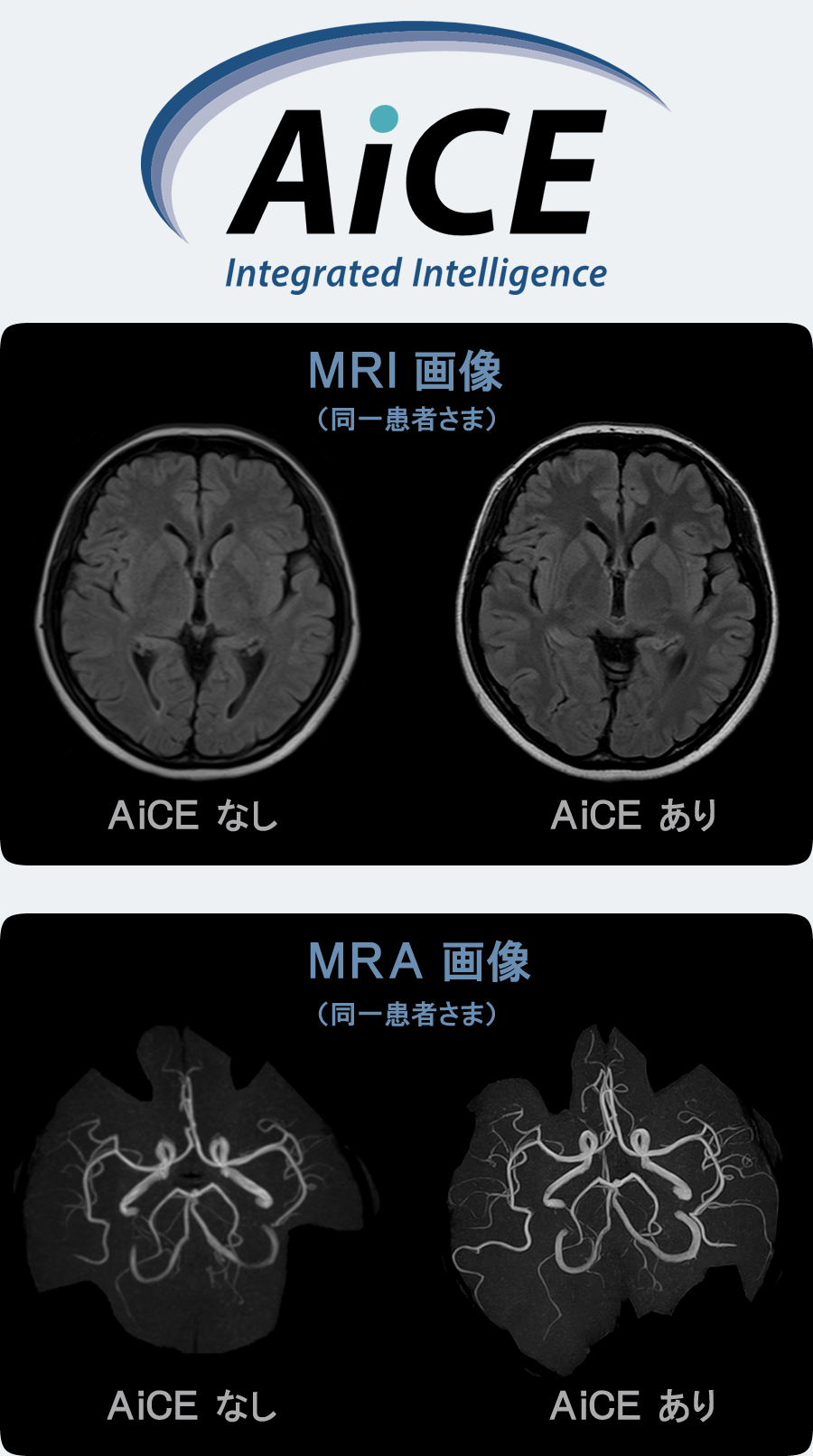 MRI検査にAI技術のAiCE導入