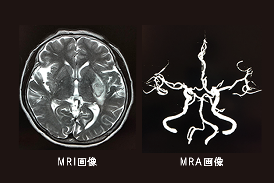 MRI検査とMRA検査の違い