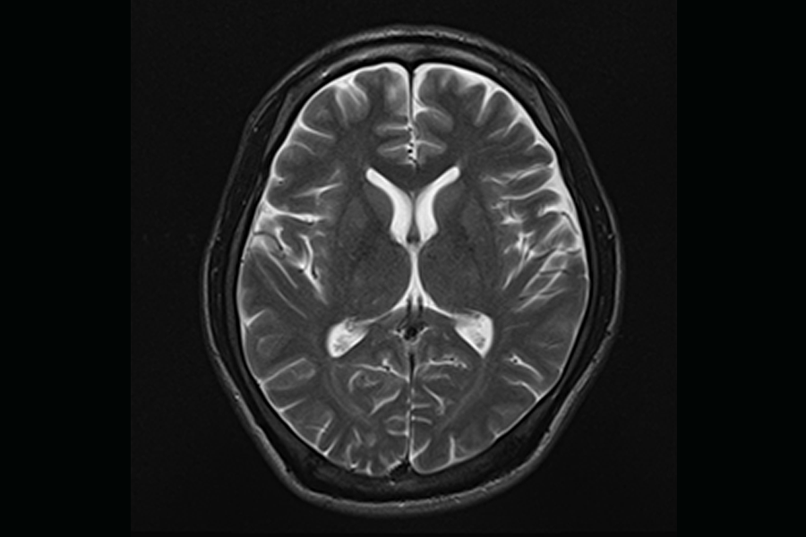 MRI画像で早期の認知症変異を抽出
